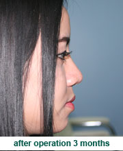 plastic_surgery_augmentation_rhinoplasty